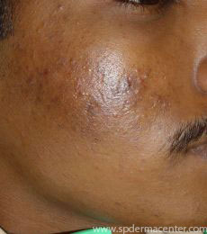 Acne-PIH-Before